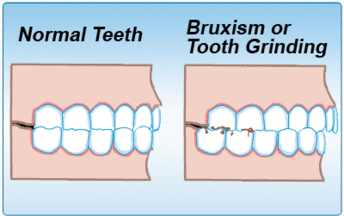 how to know if you are grinding your teeth at night